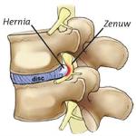 hernia